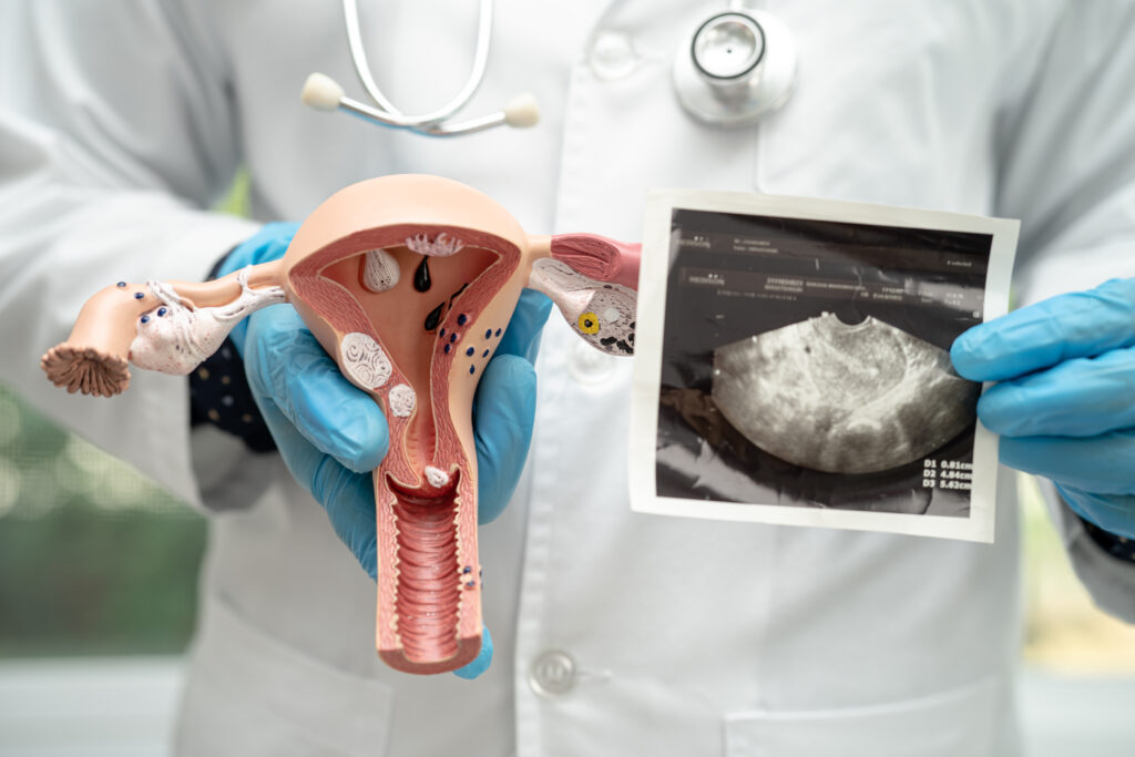 Subserosal Fibroid
