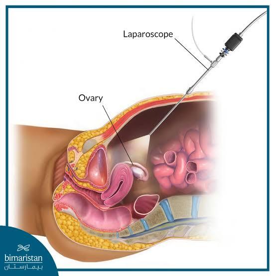 Surgical team performing a laparoscopic ovarian cystectomy in the operating theatre