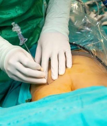 Close-up of laparoscopic instruments during ovarian cyst surgery